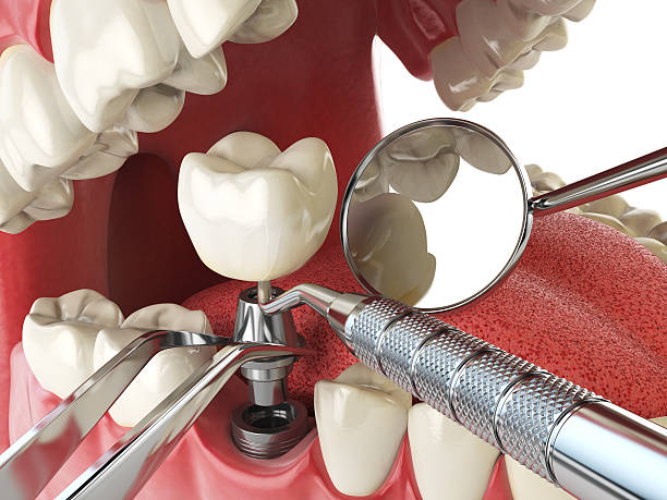 Best Emergency Tooth Extraction in Emerald Lakes, PA